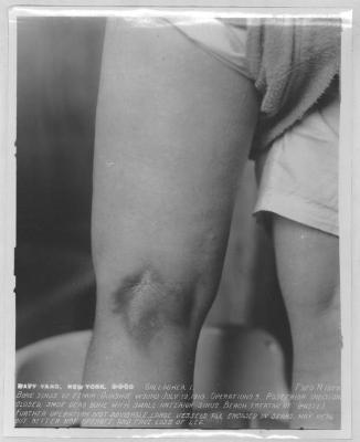 GALLAGHER I BONE SINUS OF FEMUR GUNSHOT WOUND JULY 19 1918 OPERATIONS 3 POSTERIOR INCISION CLOSED SOME DEAD BONE WITH SMALL ANTERIOR SINUS BEACH TREATMENT (PASTE) FURTHER OPERATION NOT ADVISABLE LARGE VESSELS ALL ENCASED IN SCARS MAY HEAL BUT BETTER NOT OPERATE AND FACE LOSS OF LEG
