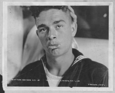 Initial Lesion of Lip